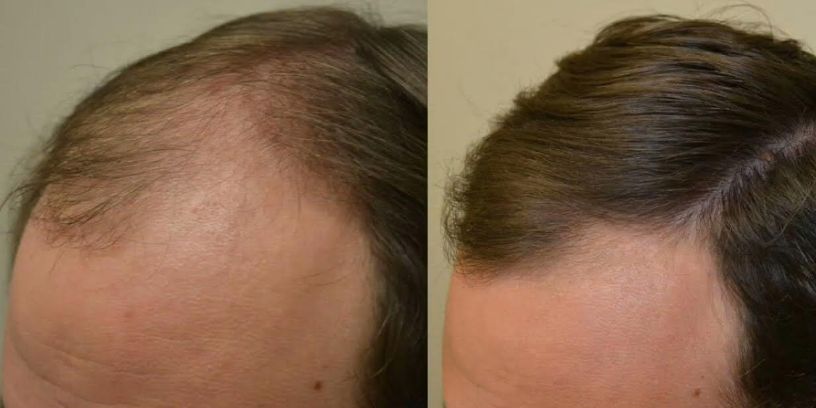 Before &After